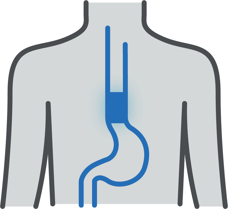 Barrett’s Esophagus